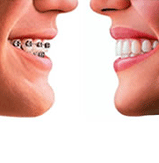 Braces