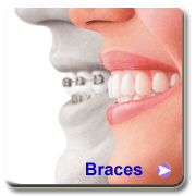 braces