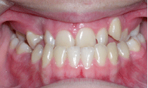 Underbite