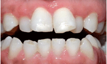 Crowded Teeth