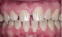 Teeth Spacing